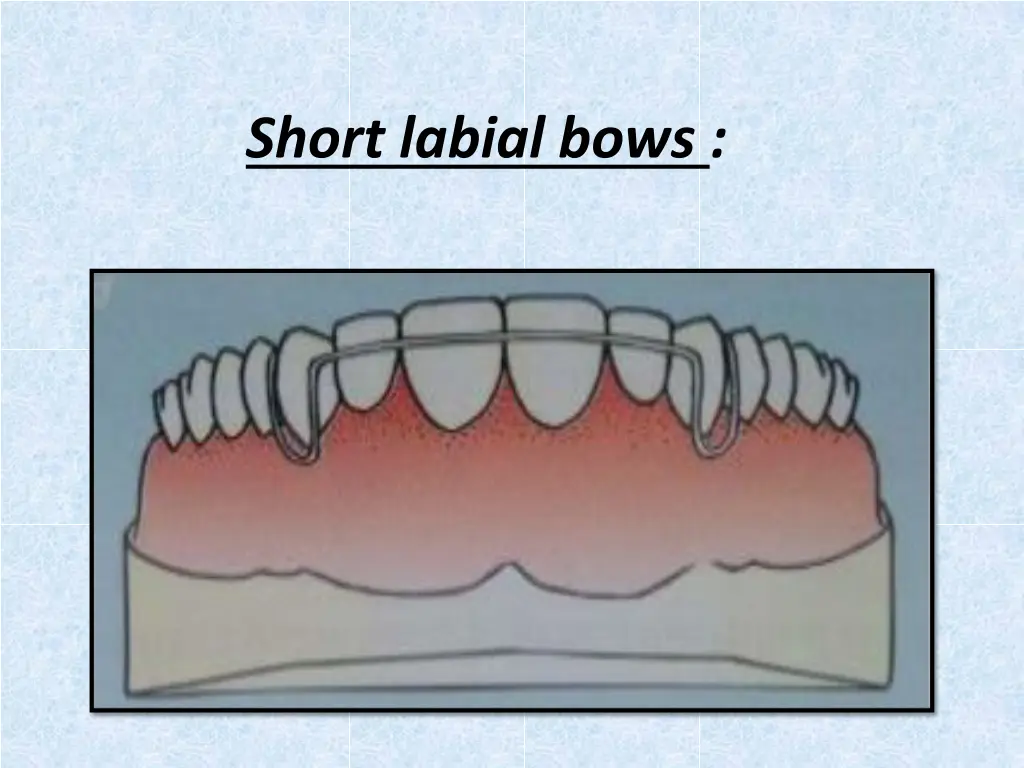 short labial bows