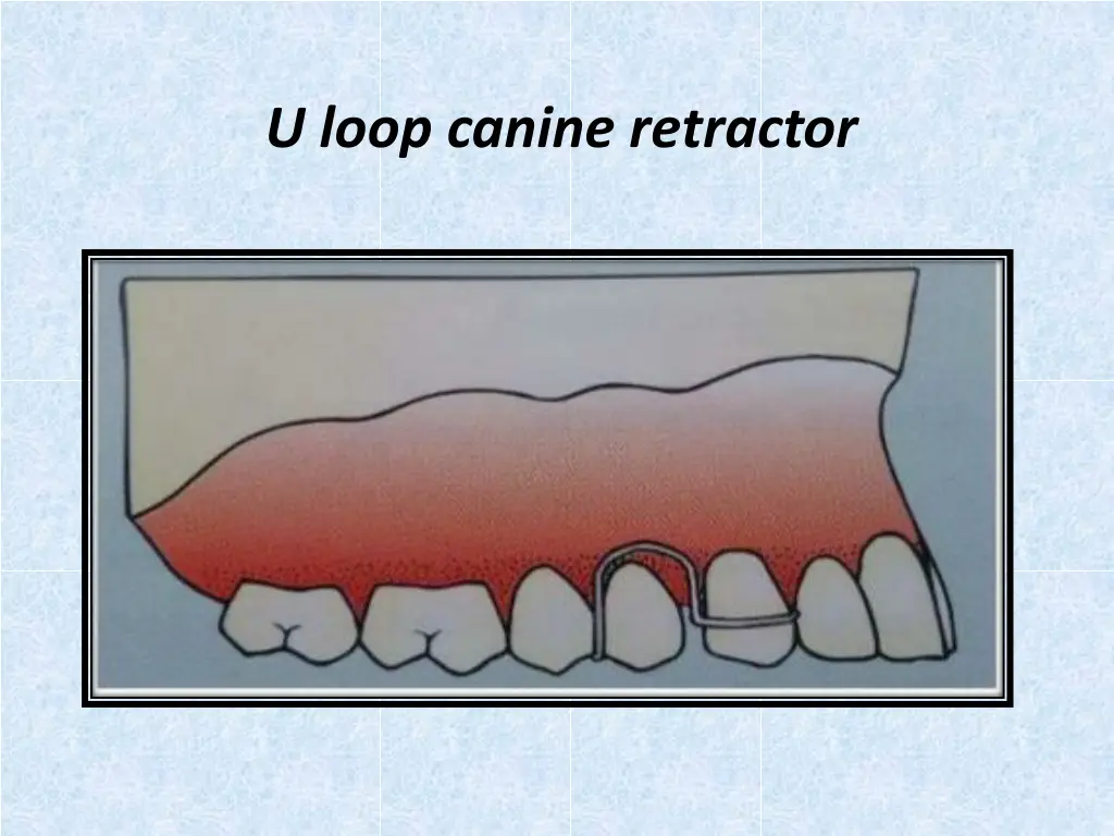 u loop canine retractor 1