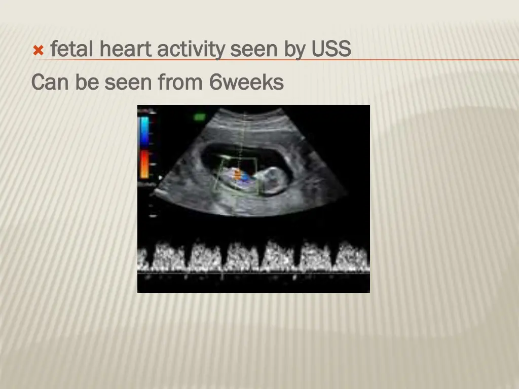 fetal heart activity seen by uss fetal heart