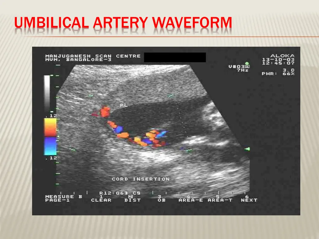 umbilical artery waveform