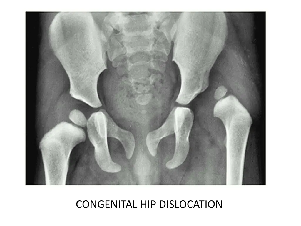 congenital hip dislocation