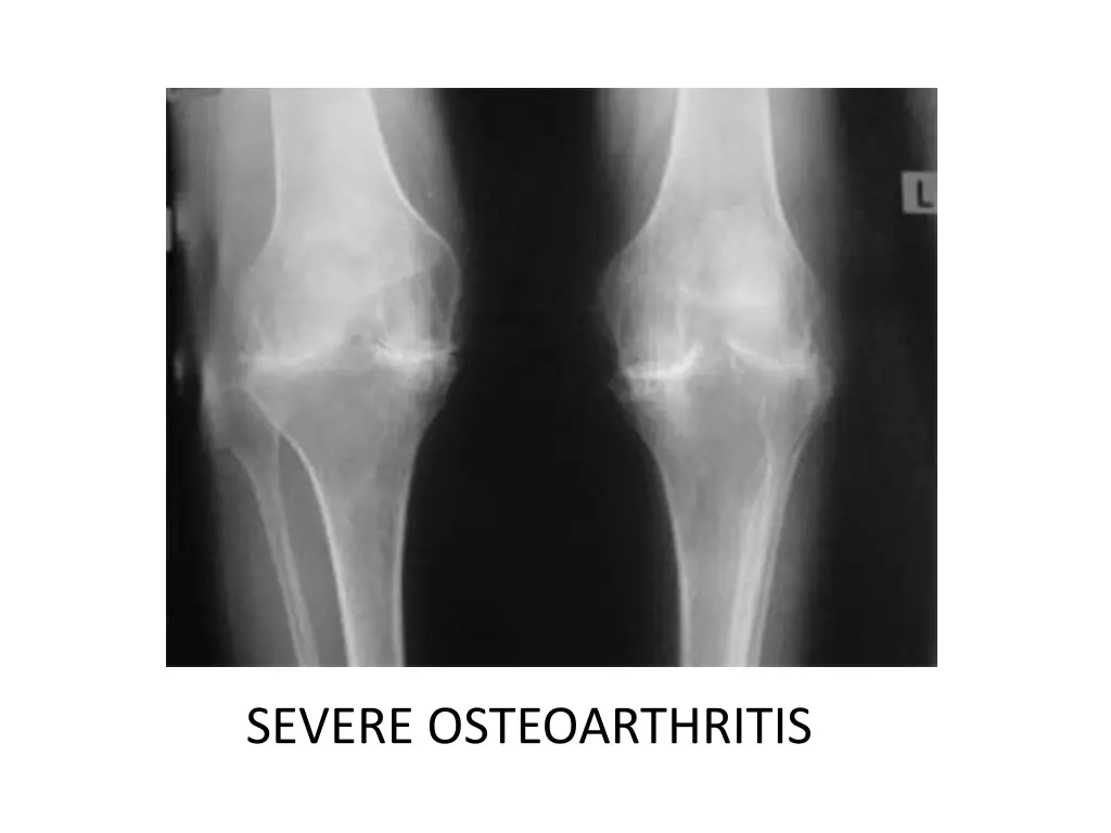 severe osteoarthritis