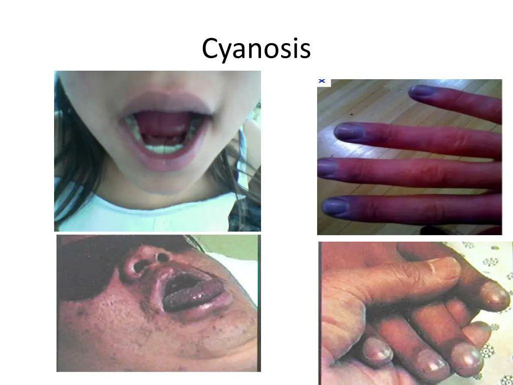 cyanosis