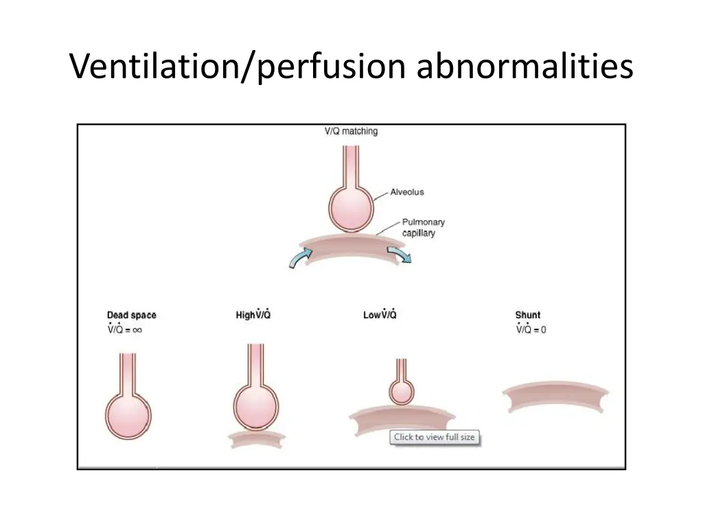 ventilation perfusion abnormalities