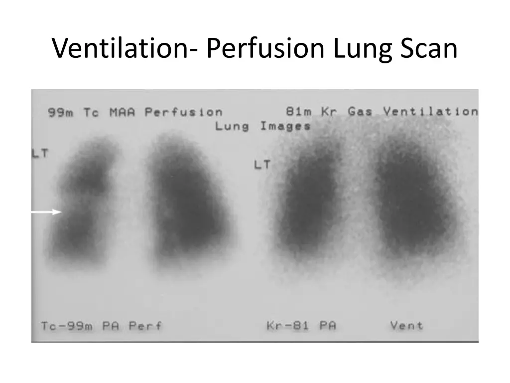 ventilation perfusion lung scan