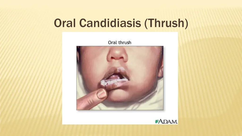oral candidiasis thrush