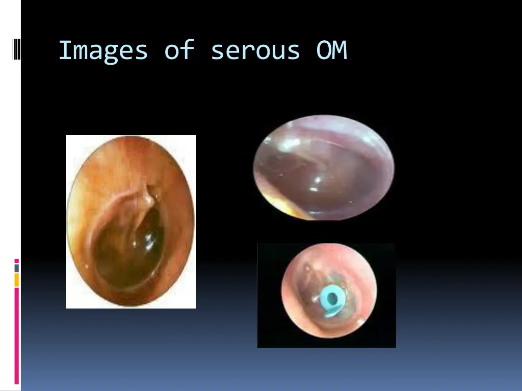 images of serous om