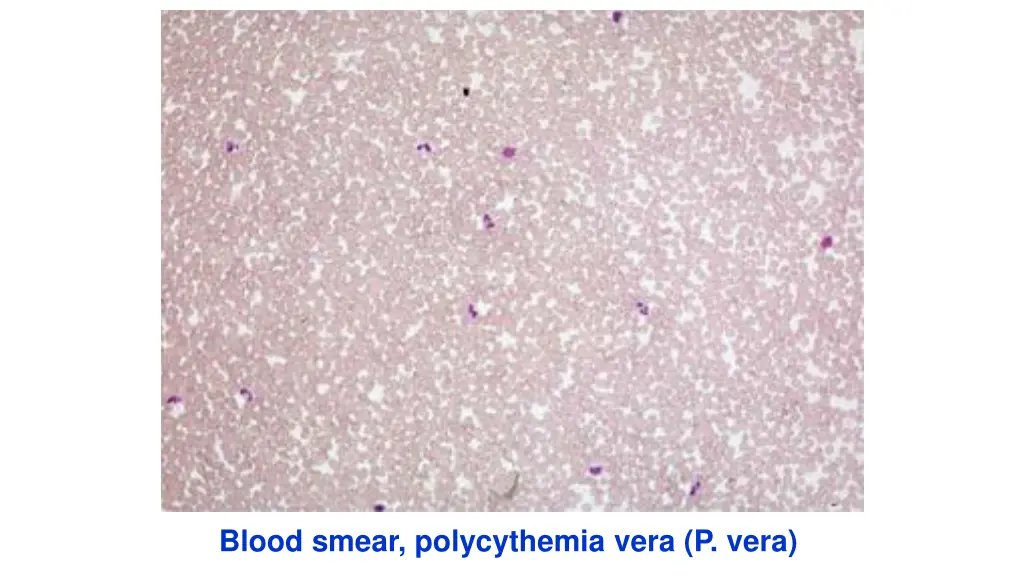 blood smear polycythemia vera p vera