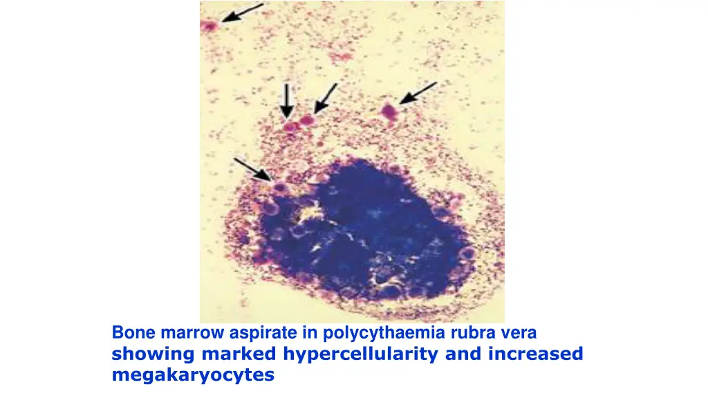 bone marrow aspirate in polycythaemia rubra vera