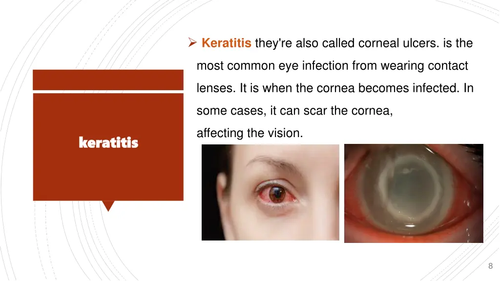keratitis they re also called corneal ulcers