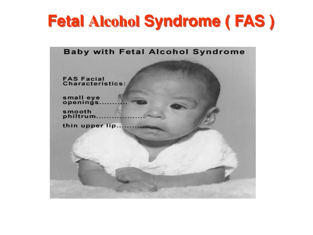 fetal alcohol syndrome fas