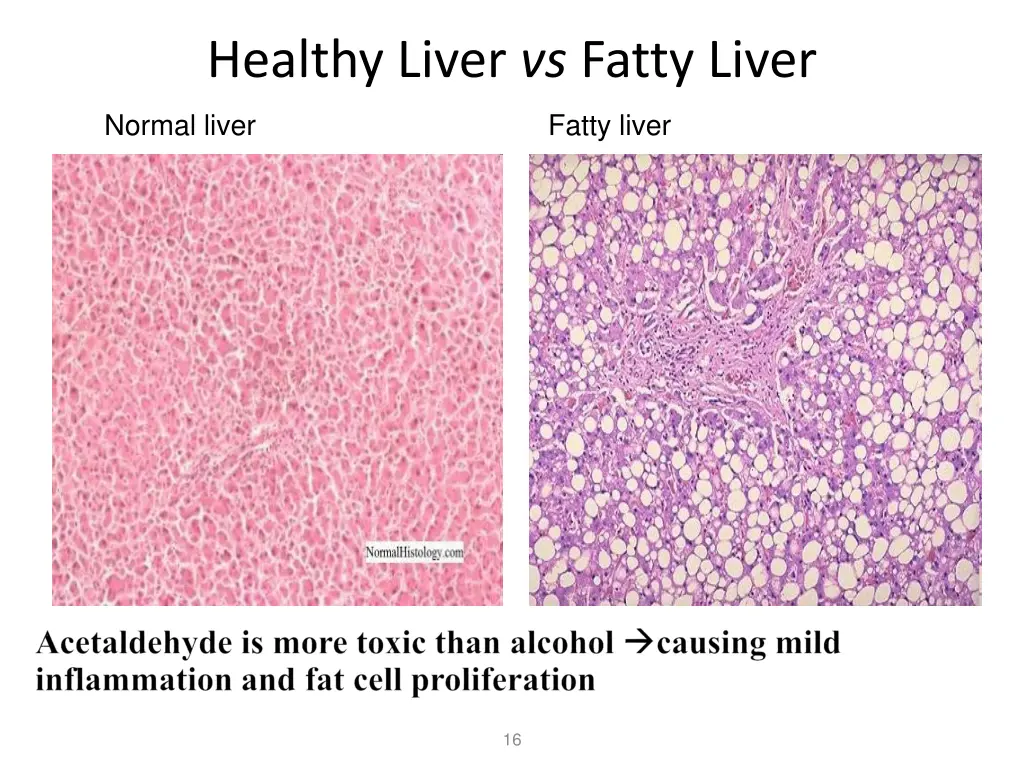 healthy liver vs fatty liver