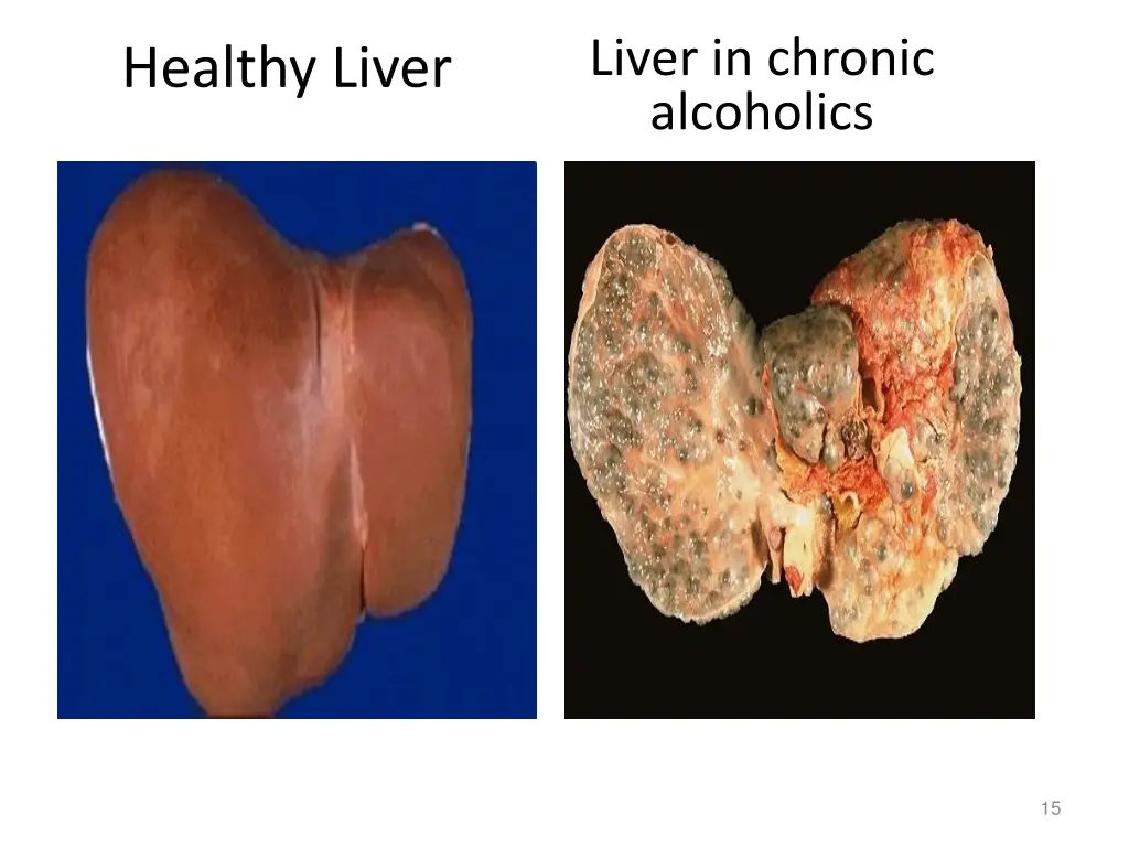 liver in chronic alcoholics