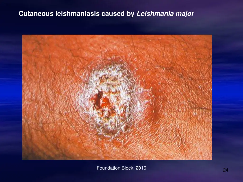 cutaneous leishmaniasis caused by leishmania major
