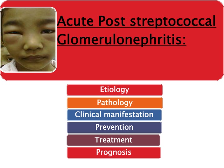 acute post streptococcal glomerulonephritis