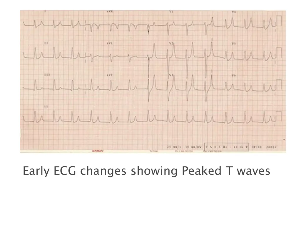 early ecg changes showing peaked t waves