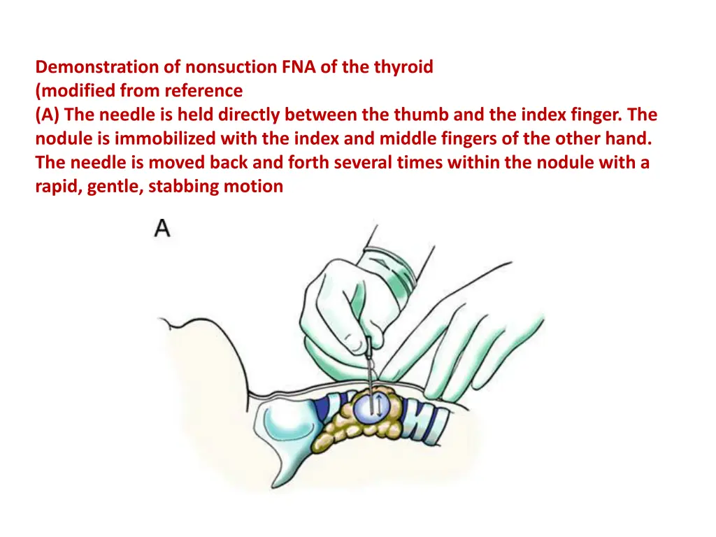 demonstration of nonsuction fna of the thyroid