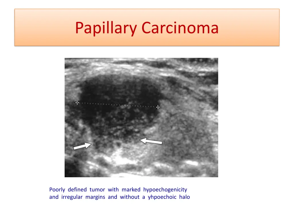 papillary carcinoma