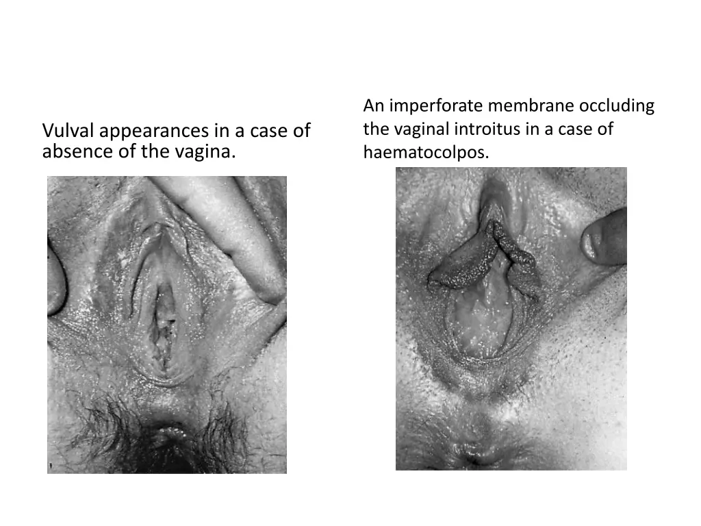 an imperforate membrane occluding the vaginal