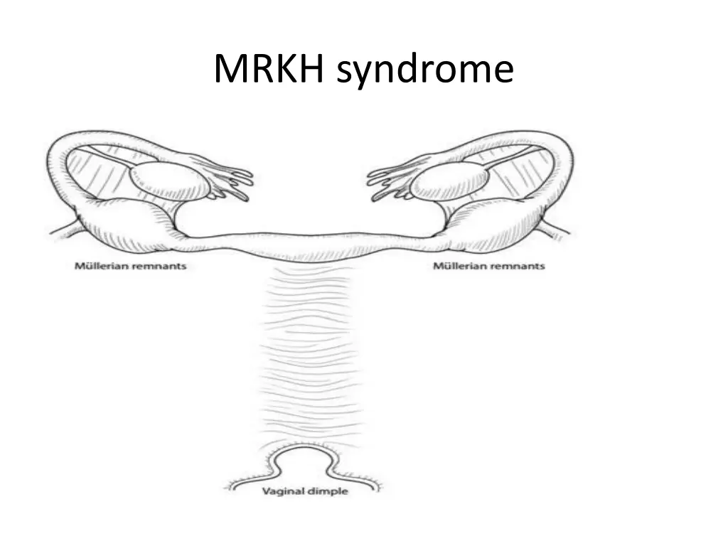 mrkh syndrome
