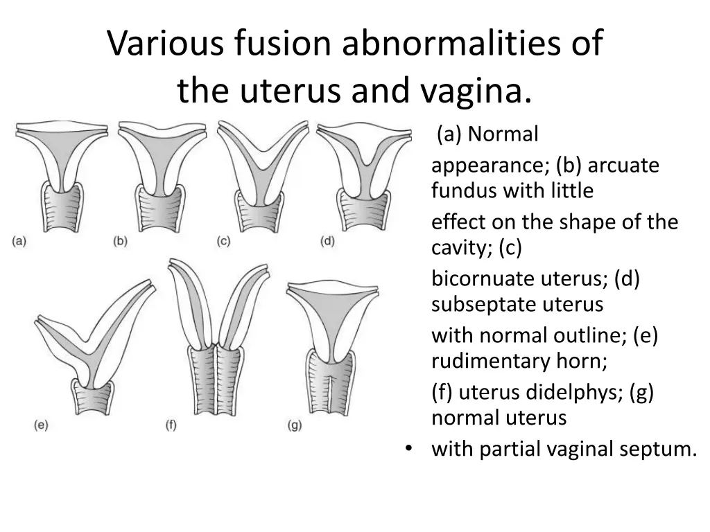 various fusion abnormalities of the uterus
