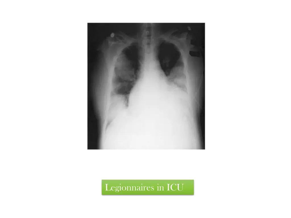 legionnaires in icu
