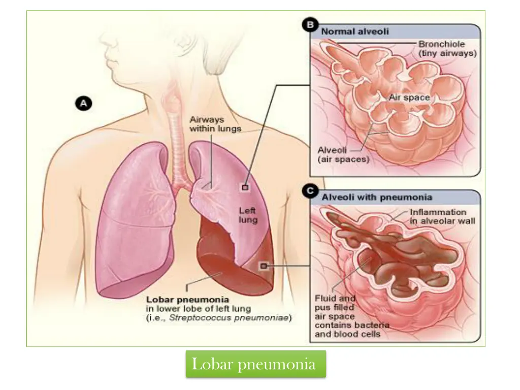 lobar pneumonia