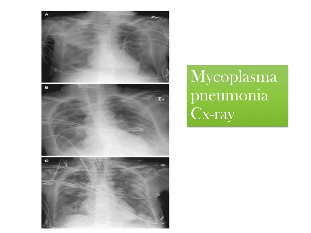 mycoplasma pneumonia cx ray
