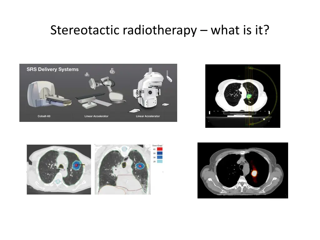 stereotactic radiotherapy what is it