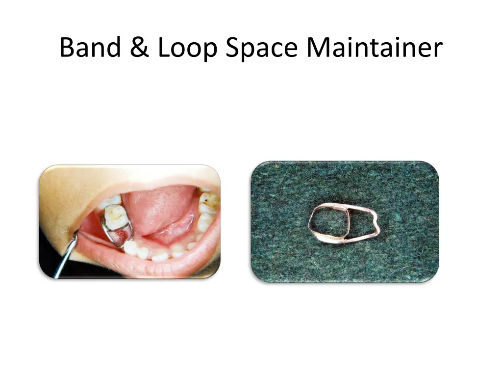 band loop space maintainer