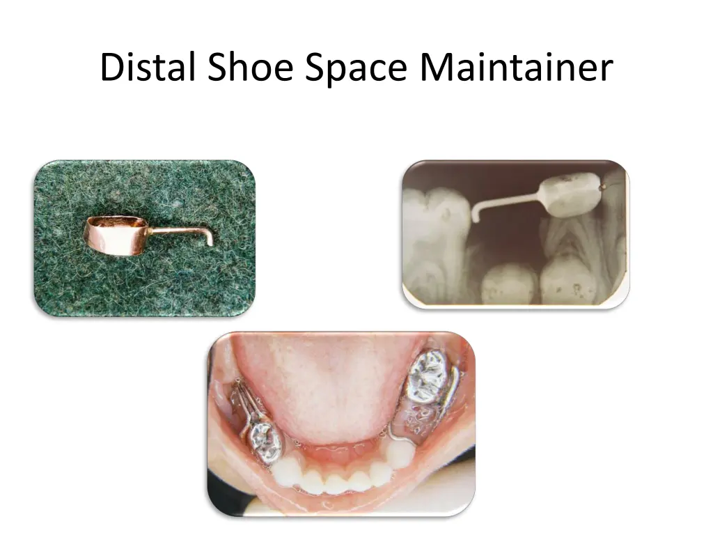 distal shoe space maintainer