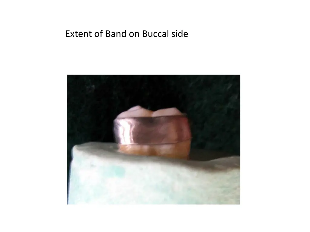extent of band on buccal side