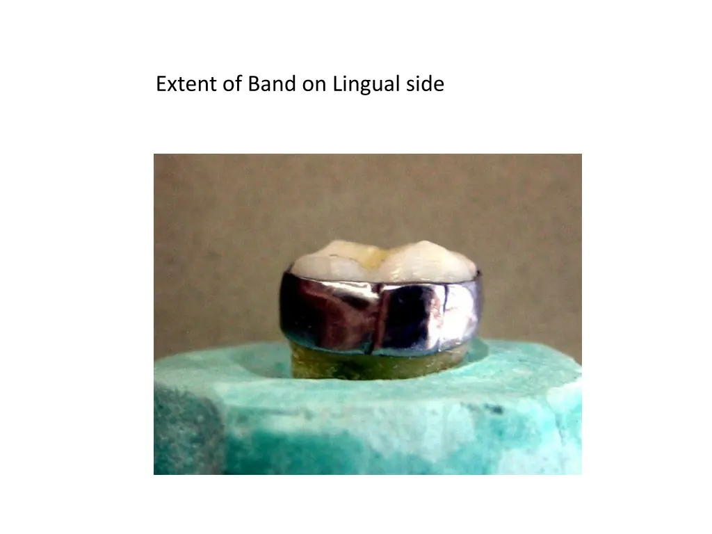 extent of band on lingual side