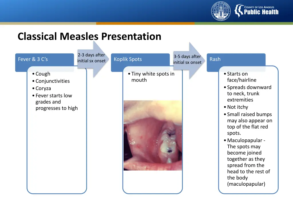classical measles presentation