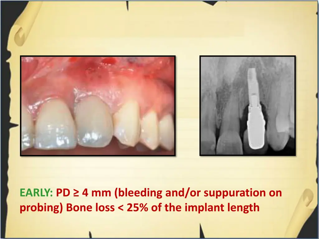 early pd 4 mm bleeding and or suppuration