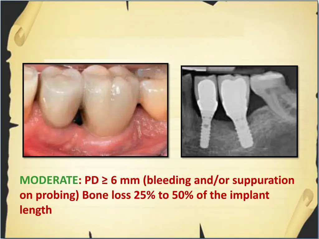 moderate pd 6 mm bleeding and or suppuration