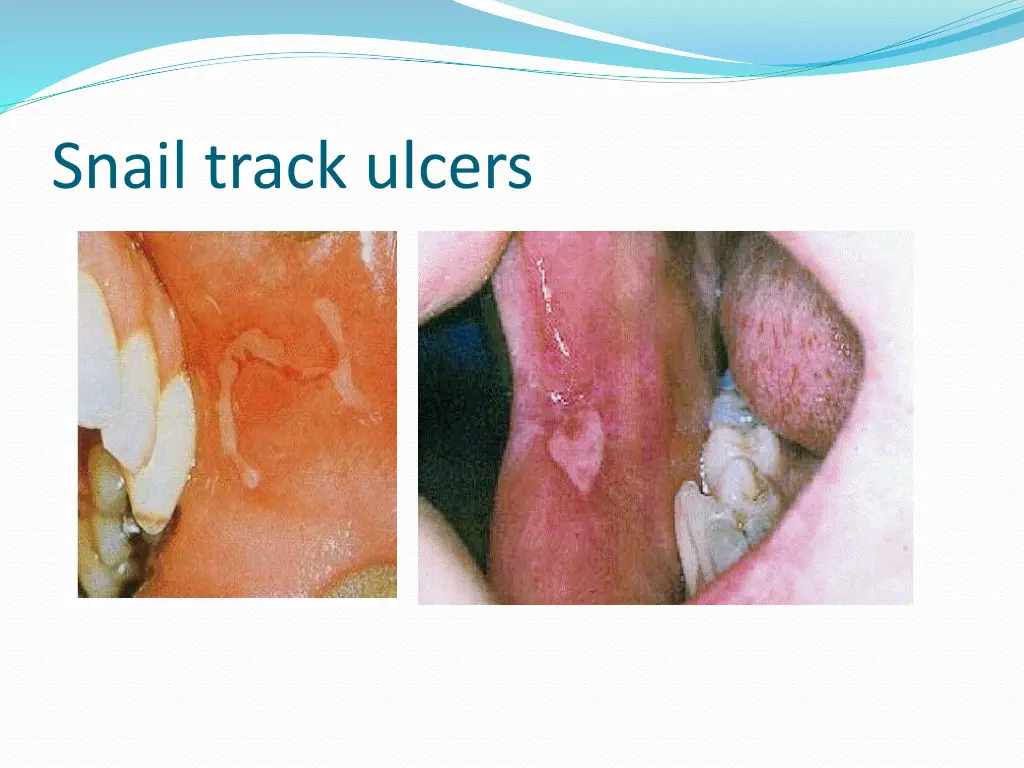 snail track ulcers
