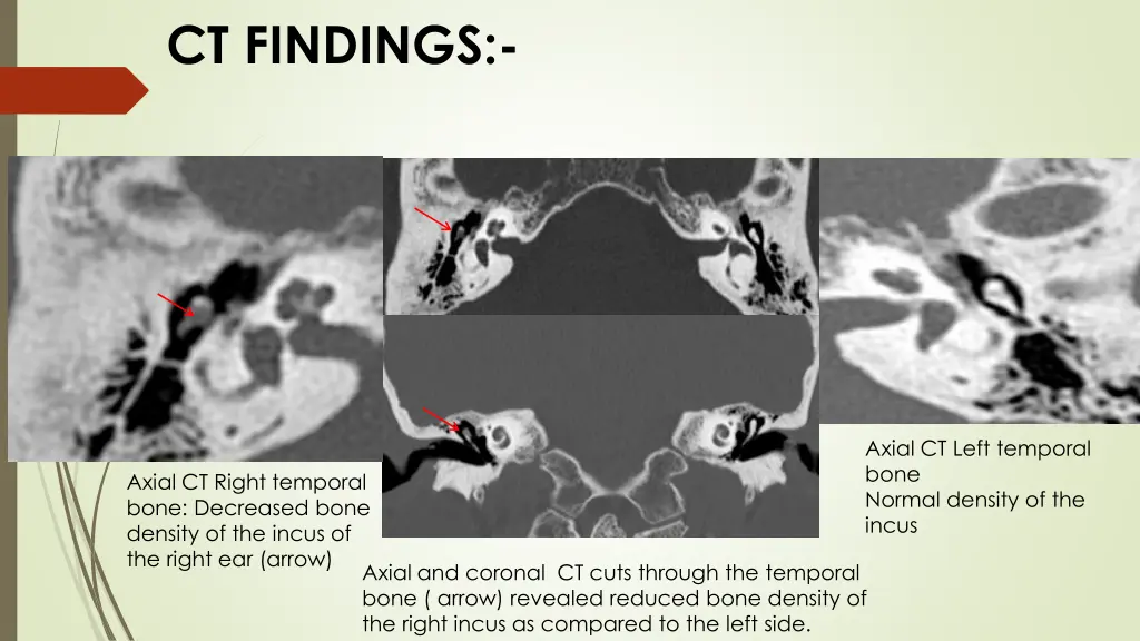 ct findings