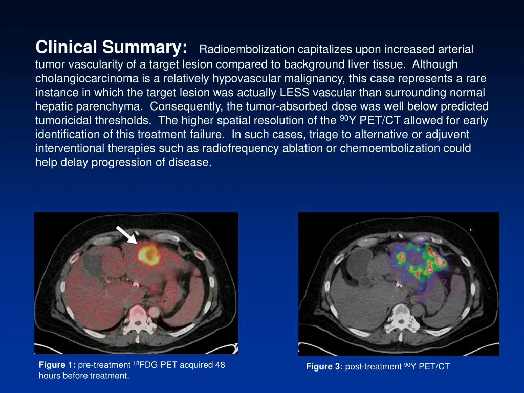 clinical summary radioembolization capitalizes