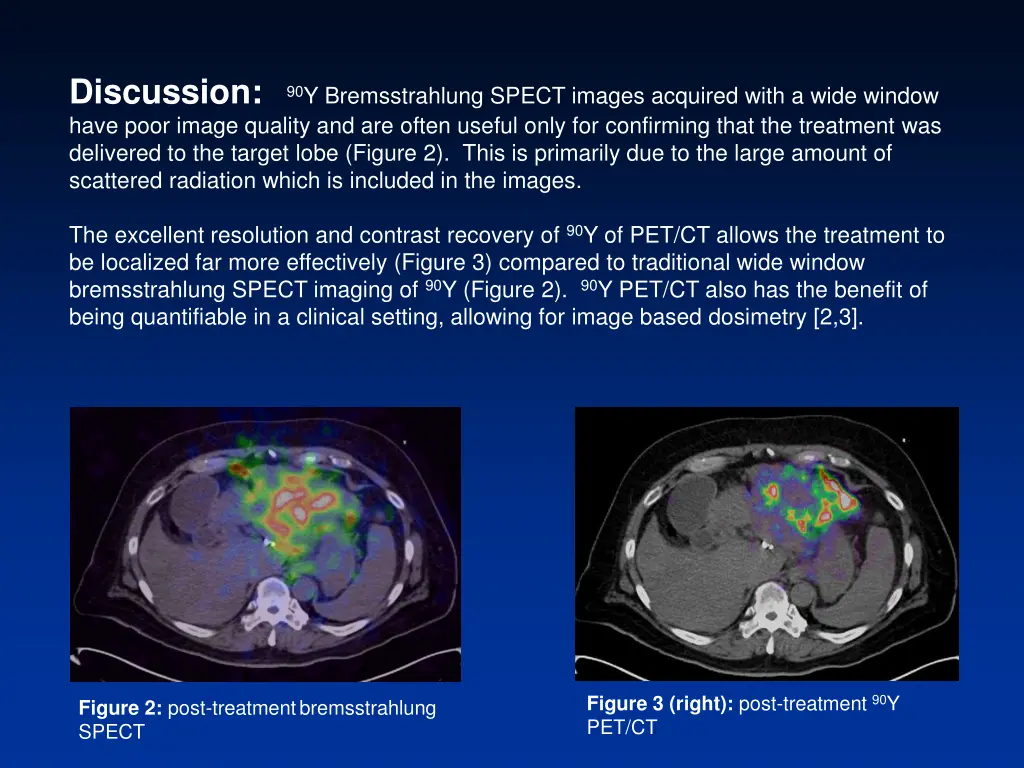 discussion 90 y bremsstrahlung spect images