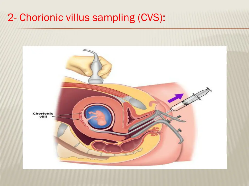 2 chorionic villus sampling cvs