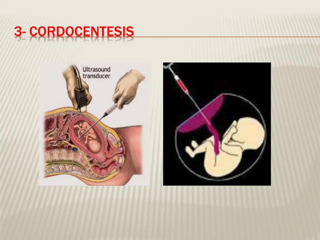 3 cordocentesis