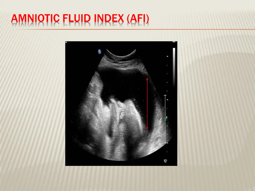 amniotic fluid index afi
