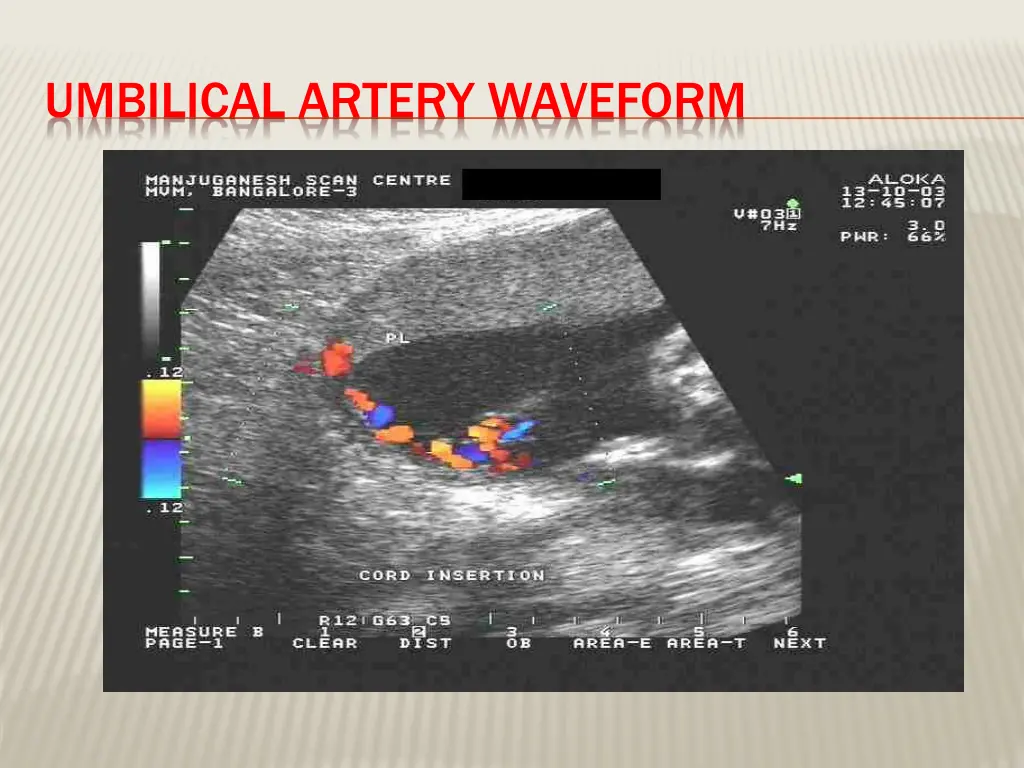 umbilical artery waveform