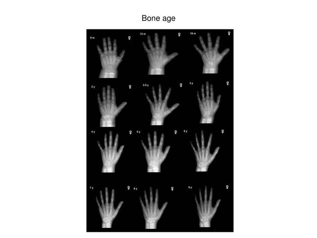 bone age