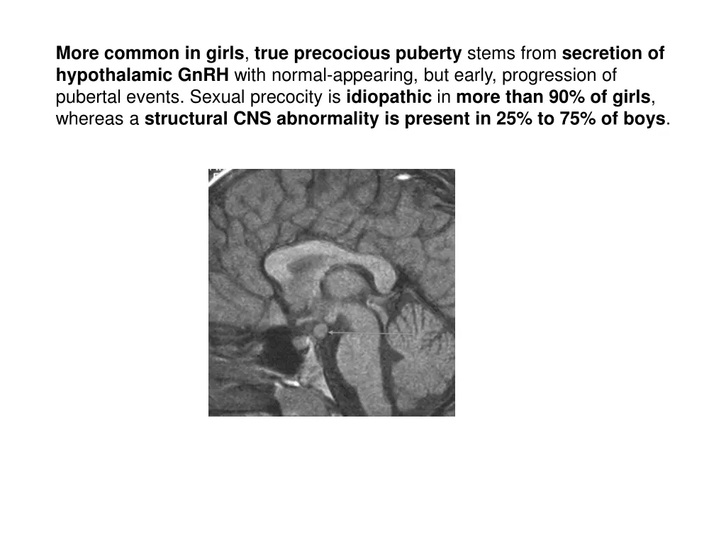 more common in girls true precocious puberty