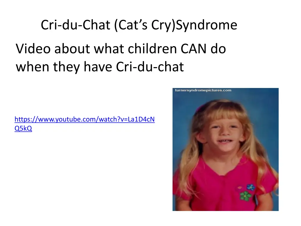 cri du chat cat s cry syndrome 1