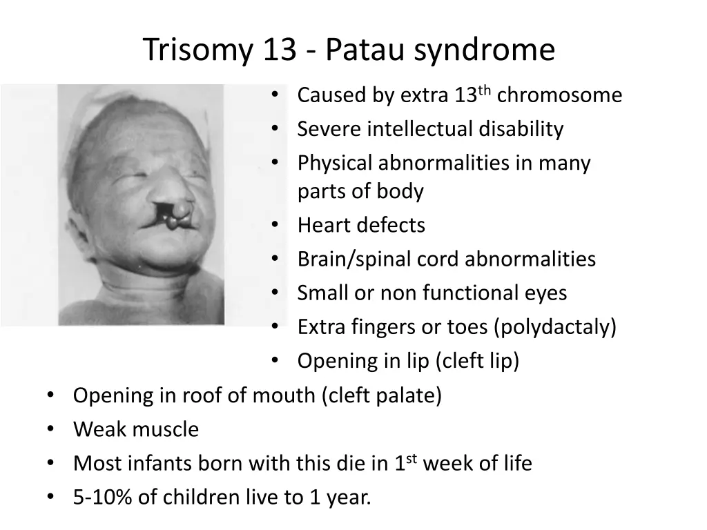 trisomy 13 patau syndrome caused by extra