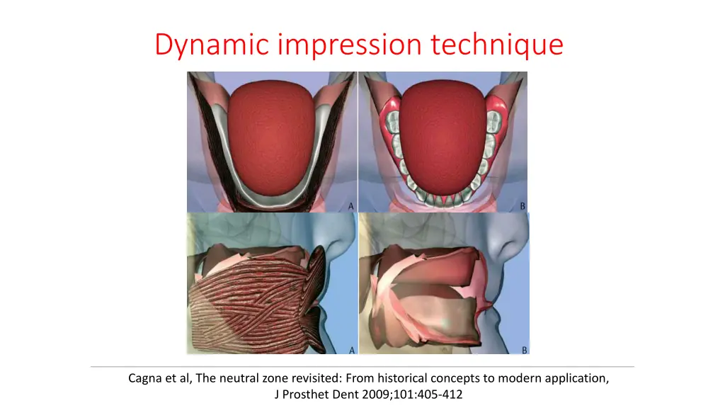 dynamic impression technique