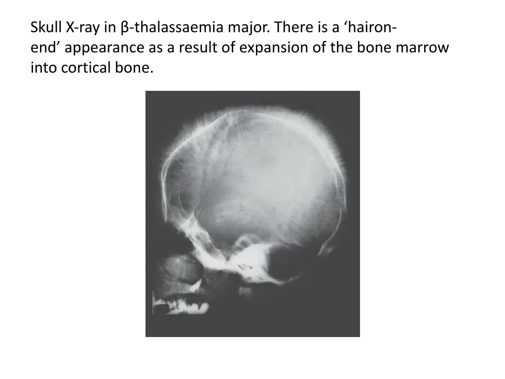skull x ray in thalassaemia major there